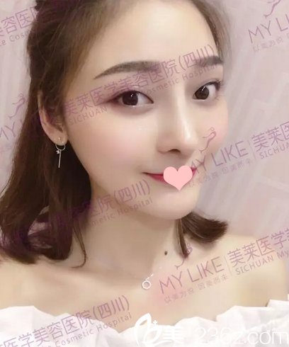 隆鼻術(shù)后1個月自拍 隆鼻術(shù)后1個月自拍