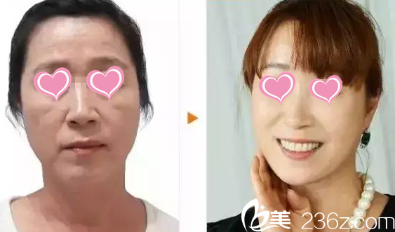 面部年輕化提升術(shù)后效果