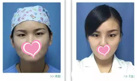 面部輪廓塑形術(shù)后