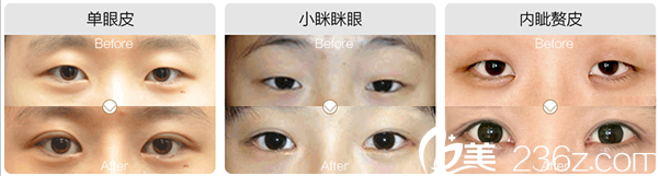 南充五星整形美容醫(yī)院雙眼皮案例錦集 南充五星整形美容醫(yī)院雙眼皮案例錦集
