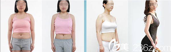 南充五星整形美容醫(yī)院360水動(dòng)力吸脂塑身案例 南充五星整形美容醫(yī)院360水動(dòng)力吸脂塑身案例