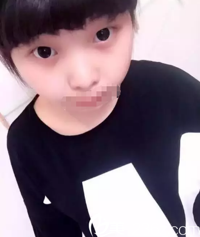 南昌五星全切雙眼皮術(shù)前照 南昌五星全切雙眼皮術(shù)前照