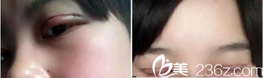 全切雙眼皮術(shù)后2天睜眼閉眼效果 全切雙眼皮術(shù)后2天睜眼閉眼效果