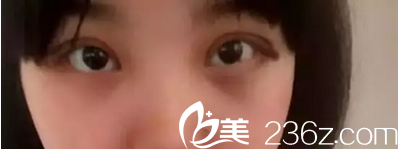 南昌五星全切雙眼皮術(shù)后5天恢復(fù)情況 南昌五星全切雙眼皮術(shù)后5天恢復(fù)情況