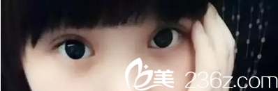 南昌五星全切雙眼皮拆線后效果 南昌五星全切雙眼皮拆線后效果