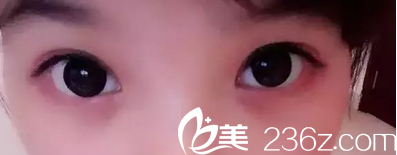 全切雙眼皮術(shù)后一個月恢復(fù)照 全切雙眼皮術(shù)后一個月恢復(fù)照