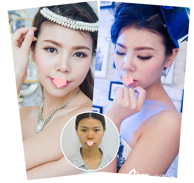 深圳<!--<i data=20240703-sp></i>-->整形科隆鼻案例展示