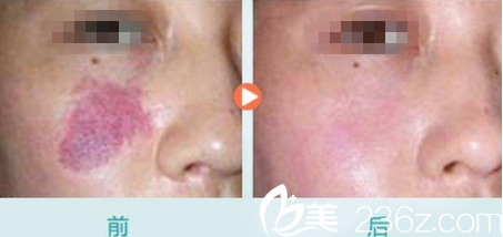  運(yùn)城華美整形劉興芳激光祛胎記