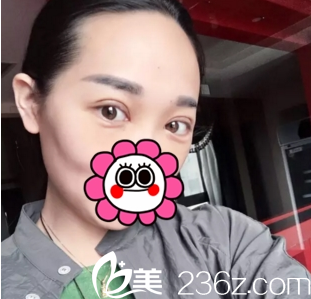 雙眼皮案例術(shù)后10天運(yùn)城華美