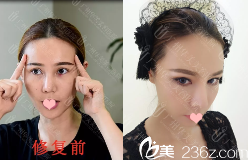 雙眼皮失敗修復(fù)前后對比圖
