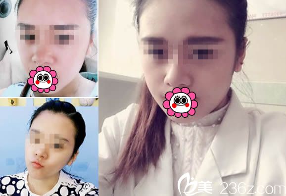 華美隆鼻效果對比圖 華美隆鼻效果對比圖