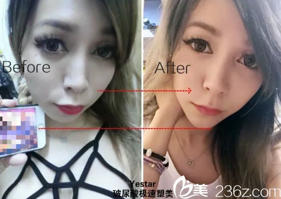 藝星做玻尿酸豐下巴前后對比圖片 藝星做玻尿酸豐下巴前后對比圖片