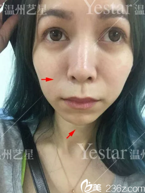 做玻尿酸填充手術前的素顏照 做玻尿酸填充手術前的素顏照