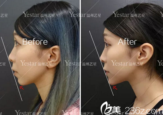 玻尿酸豐下巴手術即刻效果圖 玻尿酸豐下巴手術即刻效果圖