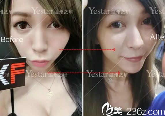 玻尿酸填充下巴和面頰正面對比照 玻尿酸填充下巴和面頰正面對比照