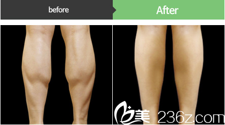 小腿太粗怎么瘦下來(lái)