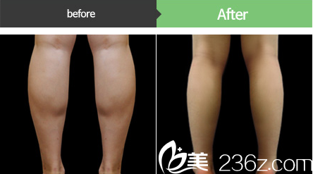 jelim李仁嬅院長(zhǎng)瘦小腿真實(shí)案例