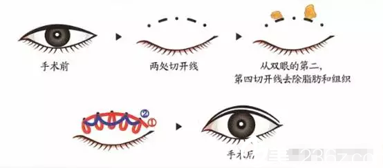 黃金五點(diǎn)翹睫重瞼術(shù) 黃金五點(diǎn)翹睫重瞼術(shù)