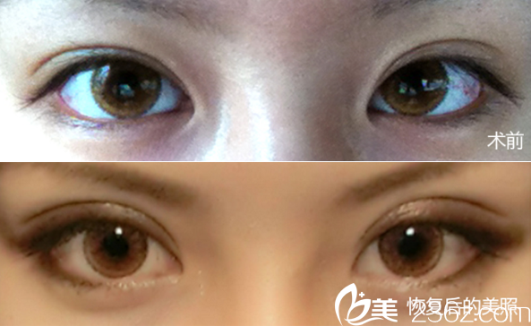 成都星美寶島雙眼皮整形案例 成都星美寶島雙眼皮整形案例