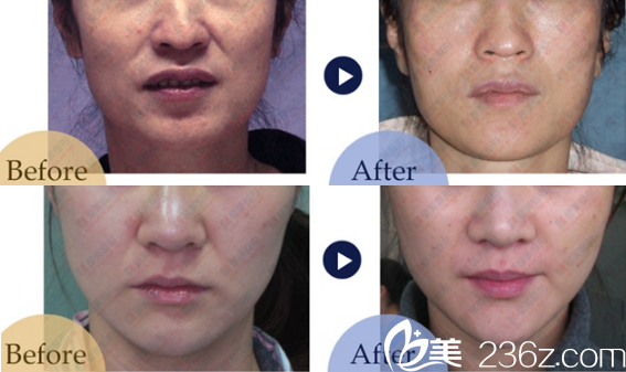 成都星美寶島TBM微創(chuàng)面部提升案例 成都星美寶島TBM微創(chuàng)面部提升案例