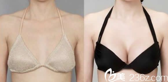 華美范志宏醫(yī)生隆胸效果 華美范志宏醫(yī)生隆胸效果