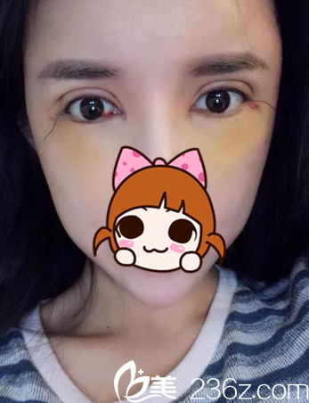 術(shù)后第二天，眼睛有點(diǎn)生硬