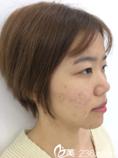 做鼻綜合整形手術(shù)前的泳泳 做鼻綜合整形手術(shù)前的泳泳