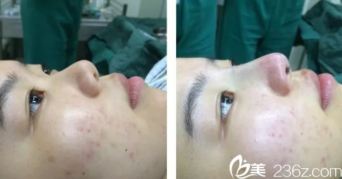 鼻綜合手術(shù)完成時<span style= 鼻綜合手術(shù)完成時<span style=