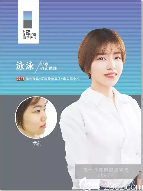 寧波和平博悅汪發(fā)生院長幫助25歲咨詢助理做鼻綜合手術(shù)成功擺脫塌肥寬形象