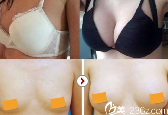華美董帆豐胸效果 華美董帆豐胸效果