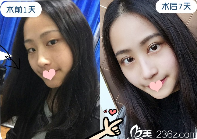 廣州星團(tuán)（原博美）醫(yī)美吳偉航醫(yī)生做的雙眼皮案例