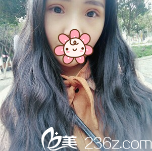 全切雙眼皮+眼瞼提肌拆線后效果 全切雙眼皮+眼瞼提肌拆線后效果