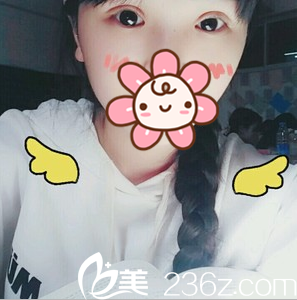 成都星美寶島全切雙眼皮術(shù)后1個(gè)月恢復(fù)情況 成都星美寶島全切雙眼皮術(shù)后1個(gè)月恢復(fù)情況