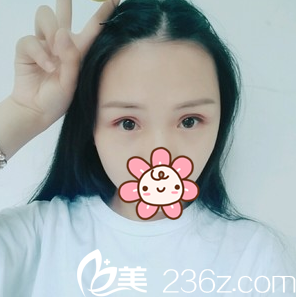 全切雙眼皮+眼瞼提肌術(shù)后3個(gè)月效果 全切雙眼皮+眼瞼提肌術(shù)后3個(gè)月效果