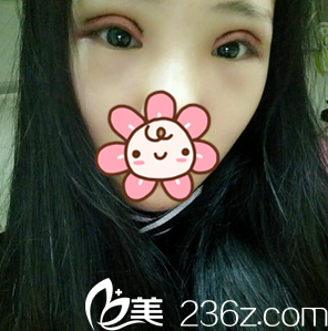 成都星美寶島全切雙眼皮+開眼角術(shù)后即可 成都星美寶島全切雙眼皮+開眼角術(shù)后即可