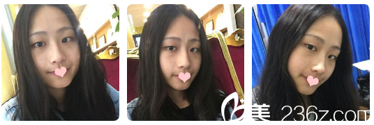 雙眼皮術(shù)前照片 雙眼皮術(shù)前照片