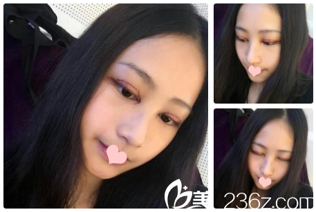 雙眼皮術(shù)后第3天恢復情況 雙眼皮術(shù)后第3天恢復情況