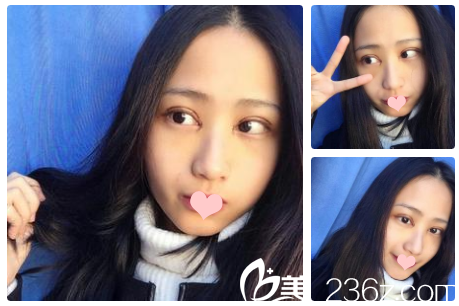 做完雙眼皮5天的樣子 做完雙眼皮5天的樣子