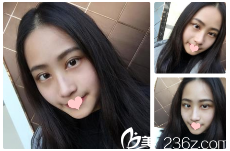 雙眼皮7天自拍 雙眼皮7天自拍