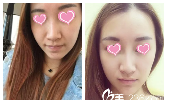 張凱華主任光子嫩膚案例 張凱華主任光子嫩膚案例