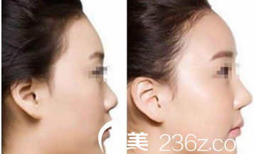 隆鼻案例重慶賽格爾整形馬強(qiáng) 