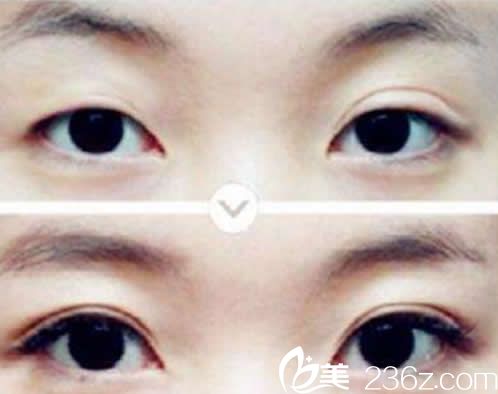華美眼部整形效果 華美眼部整形效果