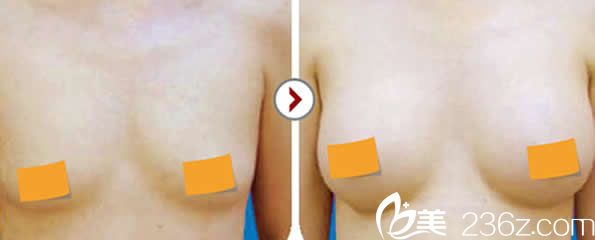 呼市華美豐胸案例 呼市華美豐胸案例