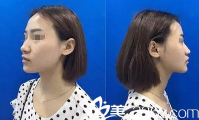 在南陽美萊做鼻綜合手術前 在南陽美萊做鼻綜合手術前