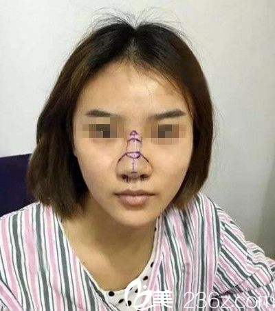 在南陽美萊做鼻綜合手術前設計 在南陽美萊做鼻綜合手術前設計