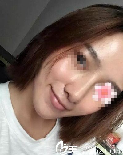 在南陽美萊做鼻綜合手術后10天 在南陽美萊做鼻綜合手術后10天