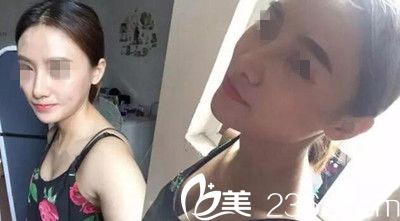 在南陽美萊做鼻綜合手術后12天 在南陽美萊做鼻綜合手術后12天