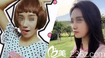 在南陽美萊做鼻綜合手術后22天 在南陽美萊做鼻綜合手術后22天