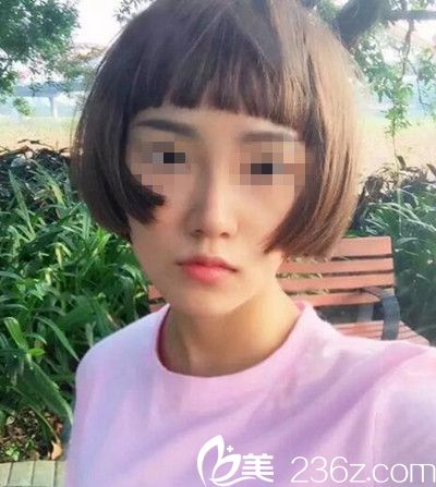 記錄我在南陽艾美花32800元做鼻綜合手術(shù)后恢復(fù)2個月的全過程