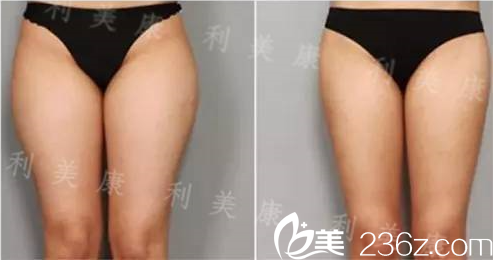 席主任做大腿吸脂術(shù)后對(duì)比